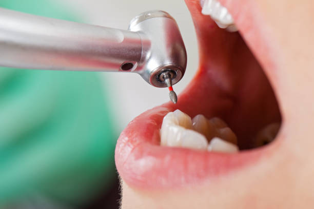 Best Emergency Dentist for Lost Fillings or Crowns in Minden, LA